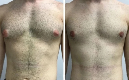 Understanding the Cost of Gynecomastia Surgery in Dubai