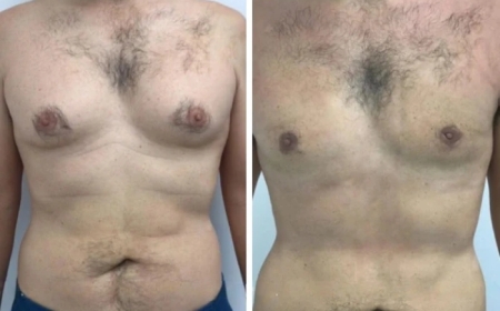 Understanding Gynecomastia in Dubai: Causes, Symptoms, and Other Treatment Options