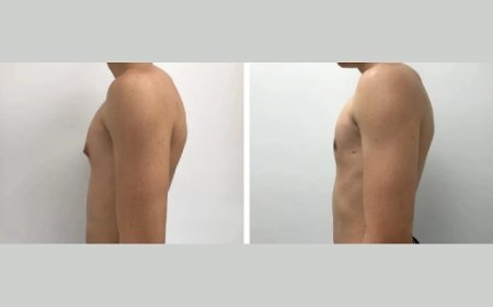 How Long Does Gynecomastia Surgery Take in Dubai