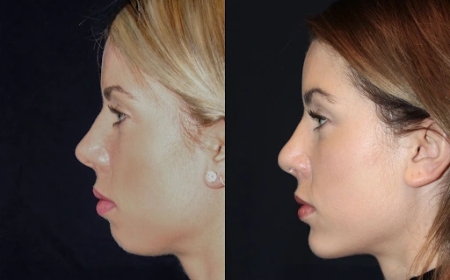 Best Plastic Surgeons in dubai for Chin Fillers: Sculpt Your Face to Perfection