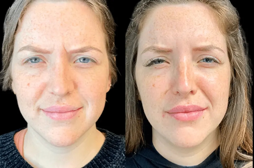 Latest Botox Innovations Offered by the Best Aesthetic Clinic in dubai