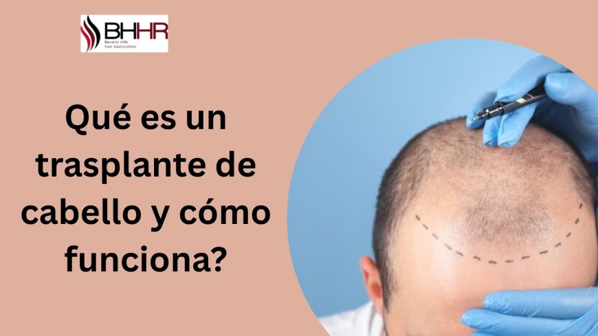 Qué es un trasplante de cabello y cómo funciona?