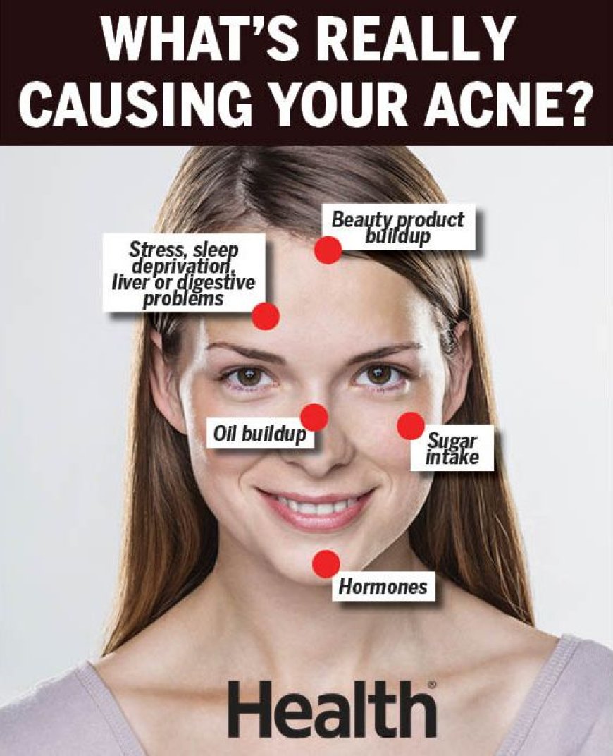 Does Smoking Weed Cause Acne Breakouts?