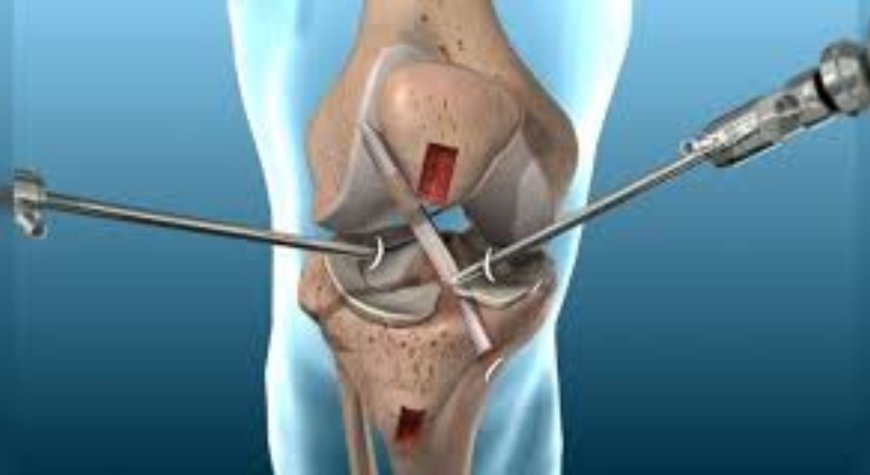 How to Choose the Best Arthroscopy Surgery In India?