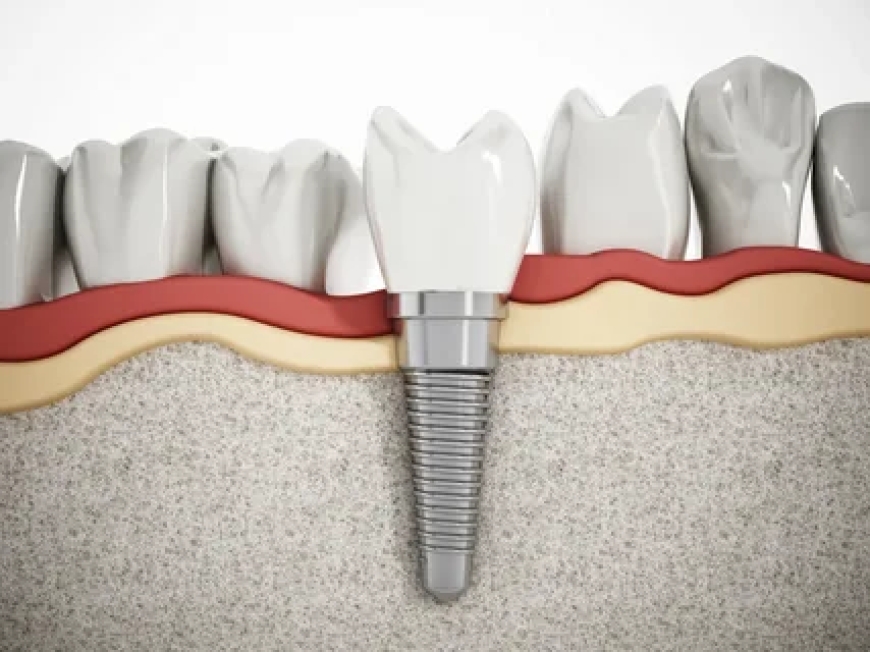 Best Dental Implant Dentist: Restore Your Smile with Expert Precision and Care