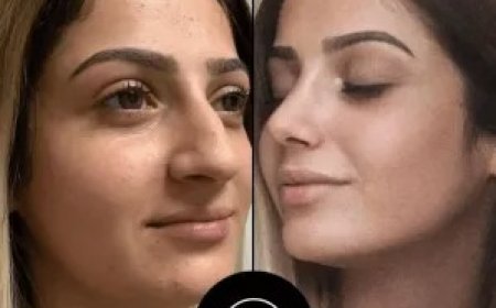 Flawless Skin Journey with the Best Aesthetic Clinic in Dubai – Perfectdrs