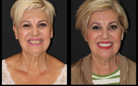 Carillas Dentales en Hospitalet de Llobregat Estética Dental de Alta Calidad