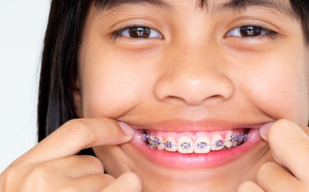 Ortodoncia Invisible en Barcelona Sonrisa Perfecta sin Brackets