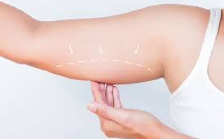 Liposuction in Islamabad – A Safe and Effective Body Contouring Option