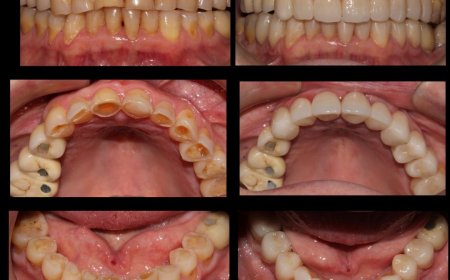 Carillas Dentales en Hospitalet de Llobregat Estética Dental de Alta Calidad
