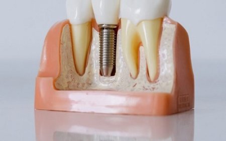 Healthy Gums and Bones with Dental Implants