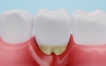 Root Canal Treatment Cost: Your Complete Guide to Affordable Dental Care