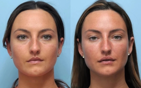 Best Plastic Surgeon in Dubai Reveals Top Benefits of Thread Lift