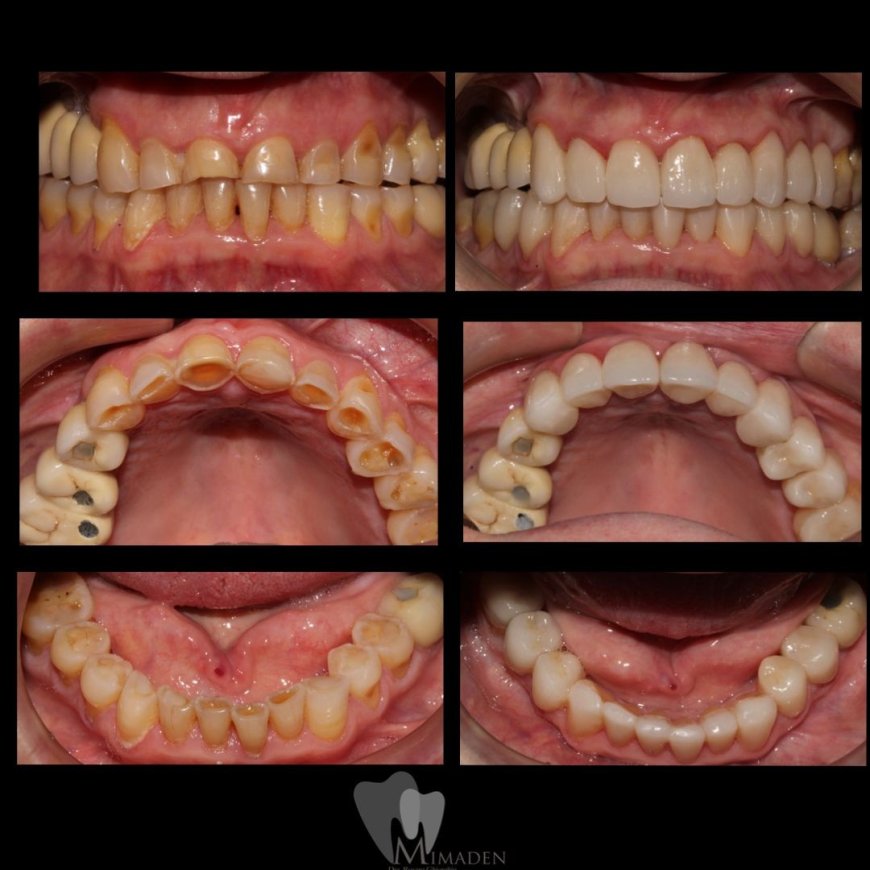 Carillas Dentales en Hospitalet de Llobregat Estética Dental de Alta Calidad