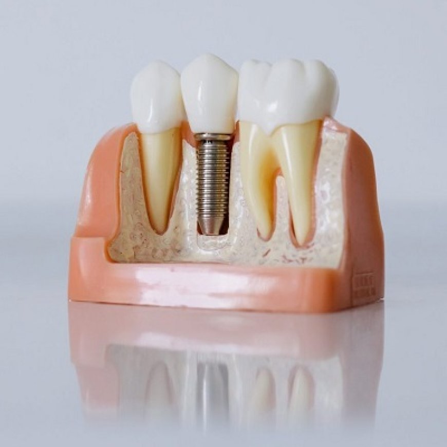 Healthy Gums and Bones with Dental Implants